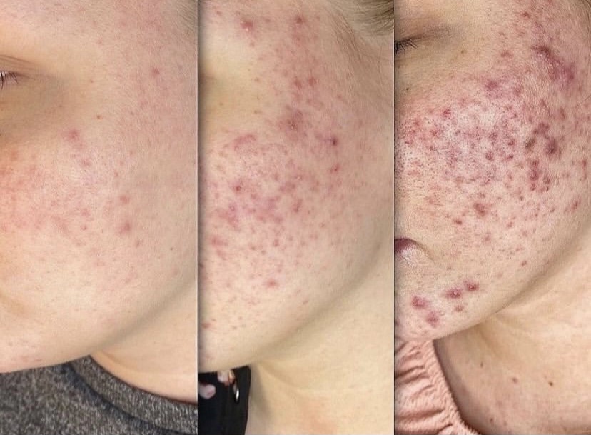 microneedling